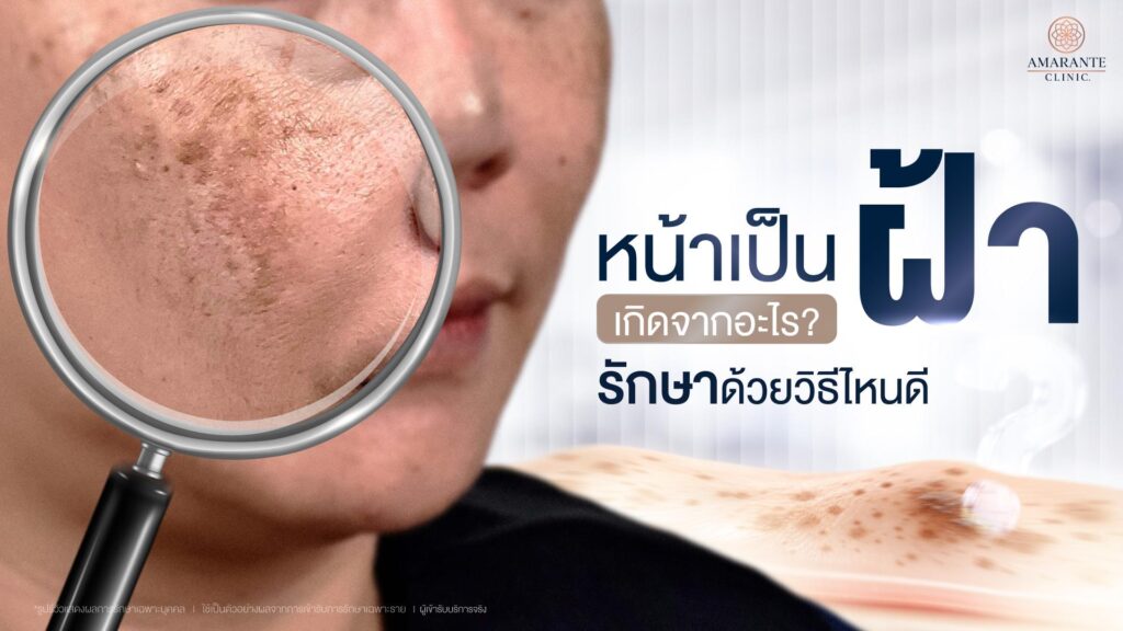 หน้าเป็นฝ้าเกิดจากอะไร? เลือกวิธีรักษาฝ้า แบบไหนดี