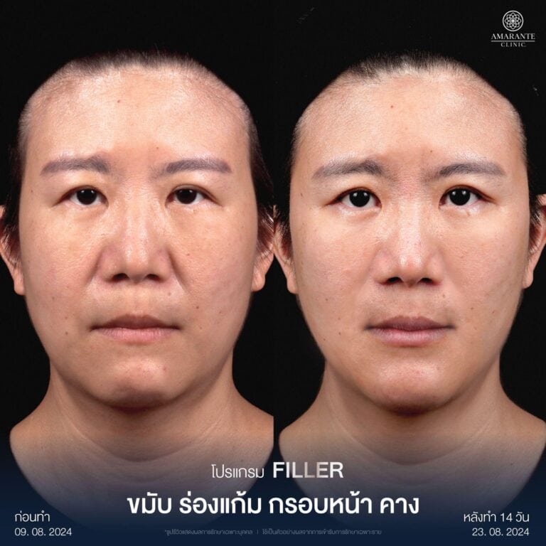 ฉีดฟิลเลอร์ร่องแก้ม