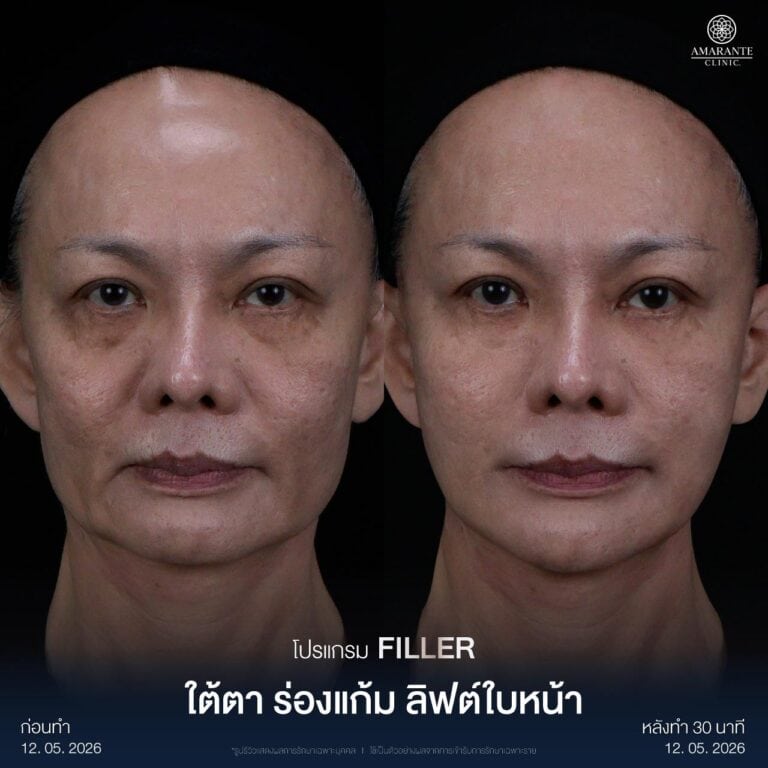 ฉีดฟิลเลอร์ร่องแก้ม