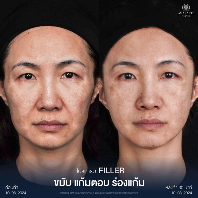 ฉีดฟิลเลอร์ร่องแก้ม