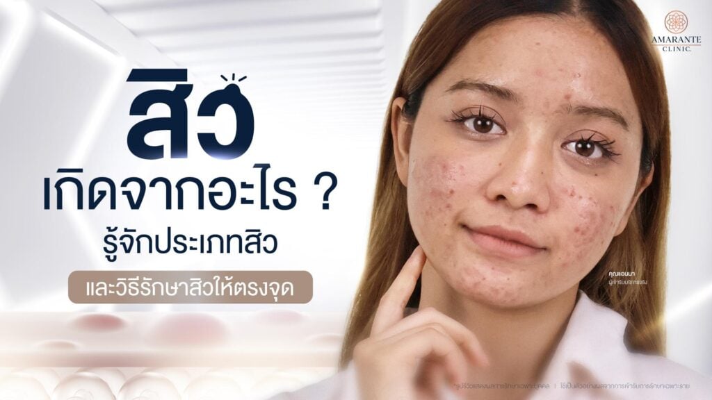 สิวเกิดจากอะไร รู้จักประเภทสิวและวิธีรักษาสิวให้ตรงจุด