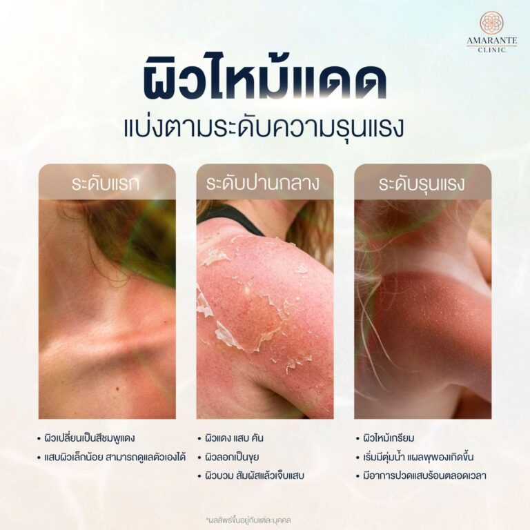 เช็กระดับความรุนแรง อาการหน้าไหม้แดด