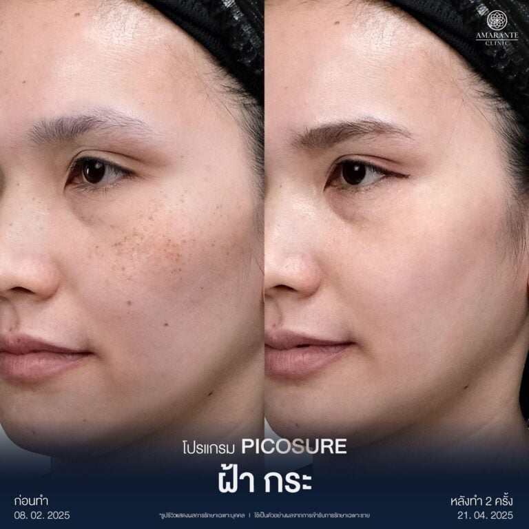รีวิว Picosure หลังรักษาผิวหน้าไหม้แดด