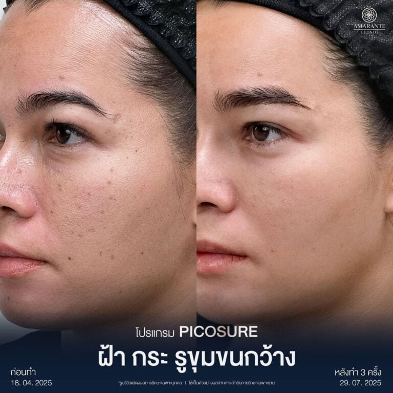 รีวิว Picosure Laser หลังรักษาผิวหน้าไหม้แดด