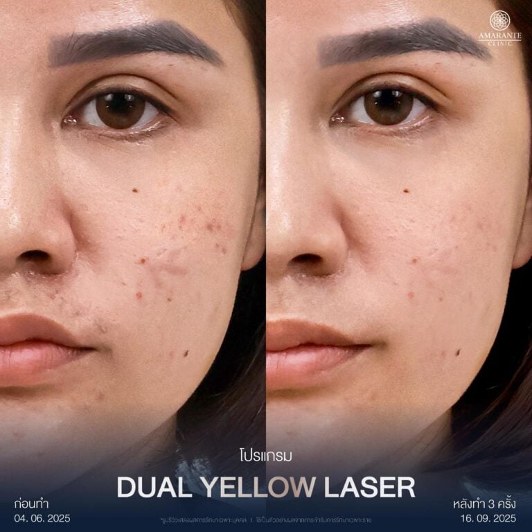 รีวิว Dual Yellow Laser หลังรักษาผิวหน้าไหม้แดด