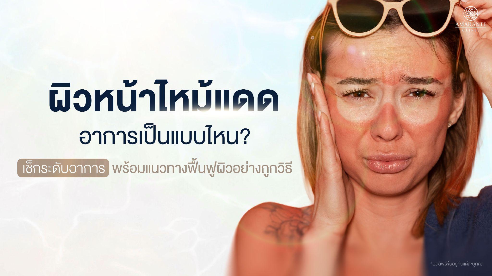 ผิวหน้าไหม้แดด อาการอย่างไรบ้าง พร้อมแนวทางฟื้นฟูผิวอย่างถูกวิธี