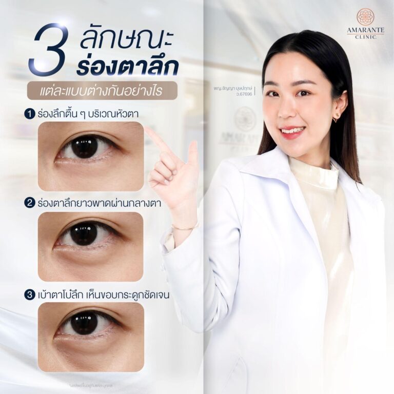 ร่องตาลึกแบบต่างๆ