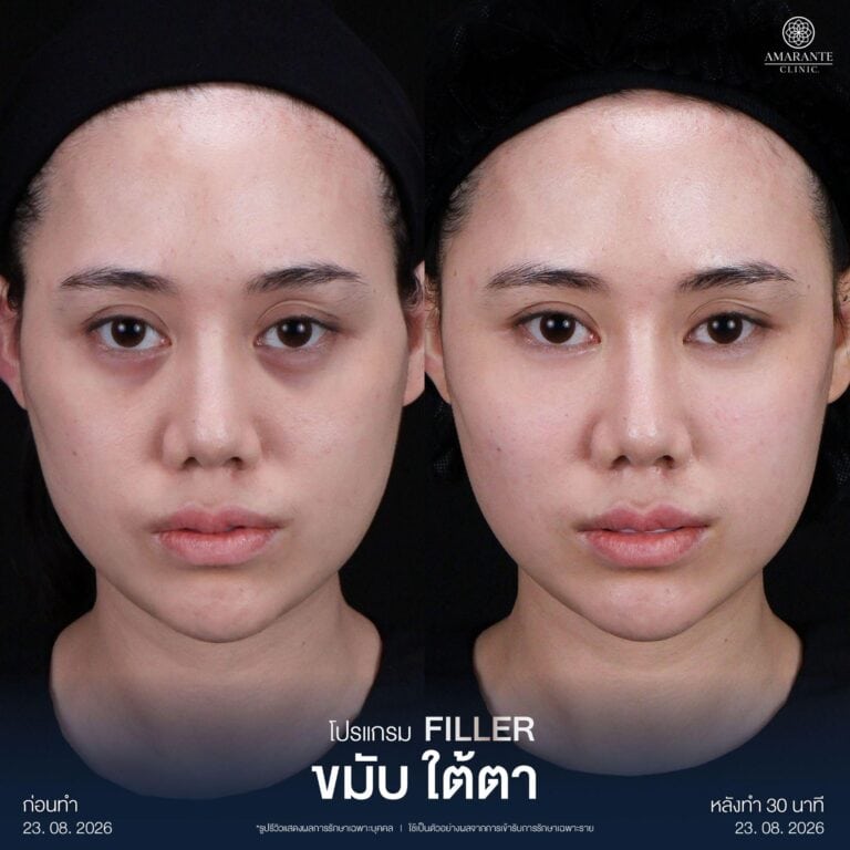 รีวิวฉีดฟิลเลอร์ใต้ตา แก้ปัญหาร่องใต้ตาลึก