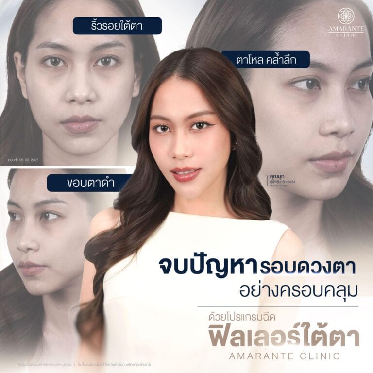 แก้ปัญหาร่องใต้ตาลึก ดวยการฉีดฟิลเลอร์ใต้ตาที่ Amarante Clinic