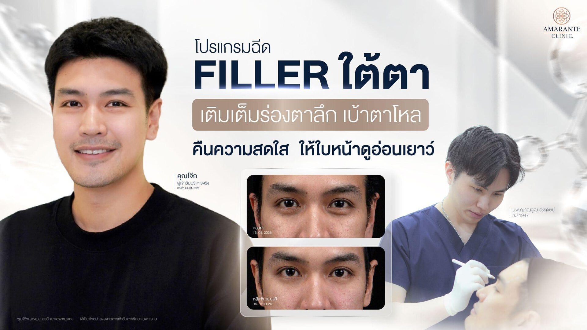 ฉีดฟิลเลอร์แก้ร่องใต้ตาลึก เบ้าตาโหล