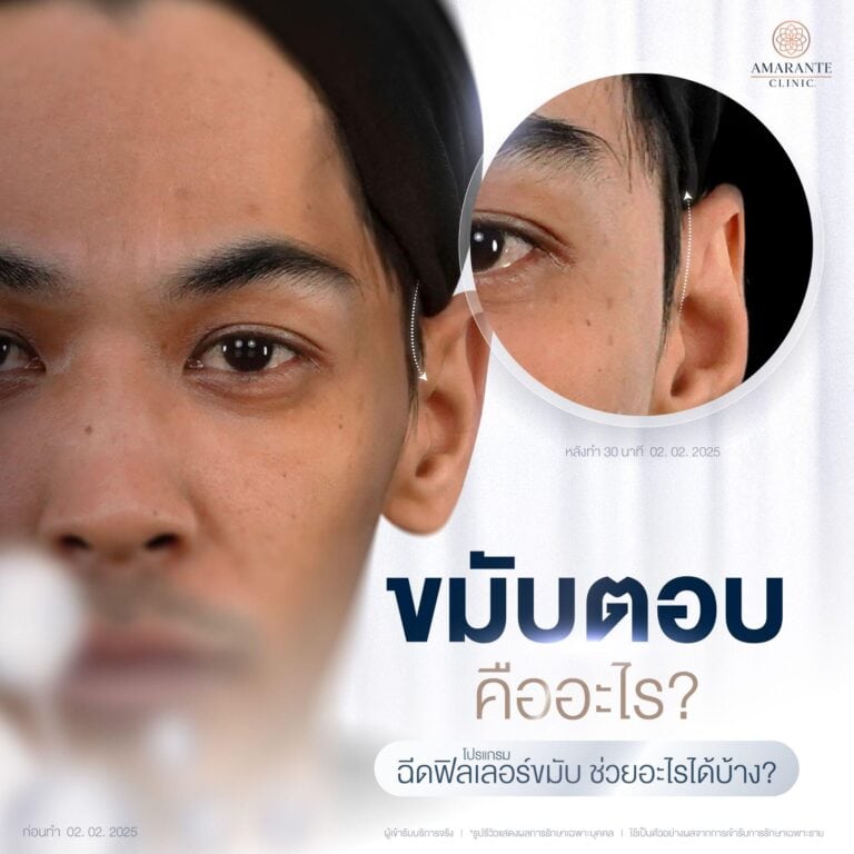 ฟิลเลอร์ขมับ คืออะไร? ช่วยเรื่องอะไร