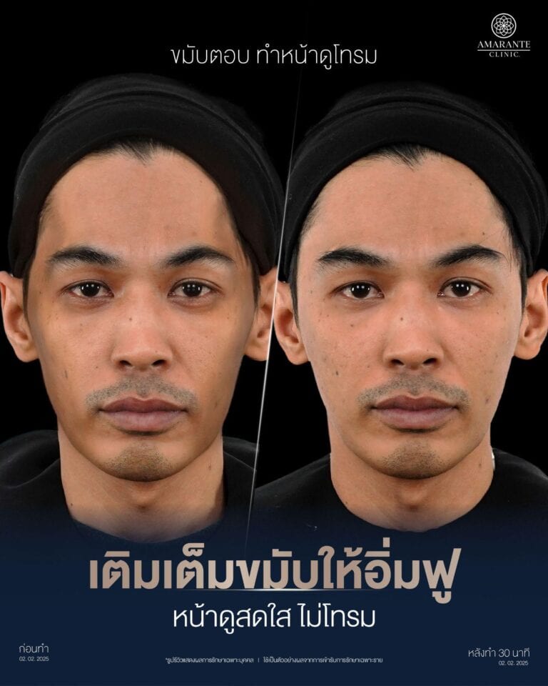 รีวิวฉีดฟิลเลอร์ขมับ แก้ปัญหาขมับตอบ